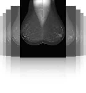 Sistemul de mamografie cu tomosinteza - Clarity 3D, Planmed